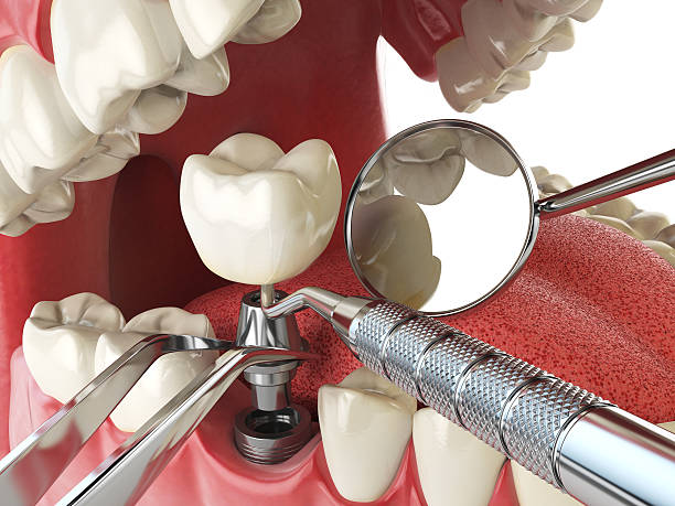 Best Knocked-Out Tooth (Avulsed Tooth) Treatment in Ashland City, TN